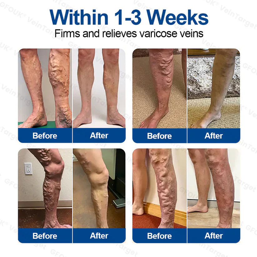 🧙GFOUK® VeinTarget Microneedle Patch⚡Instant Relief, Long-Term Results