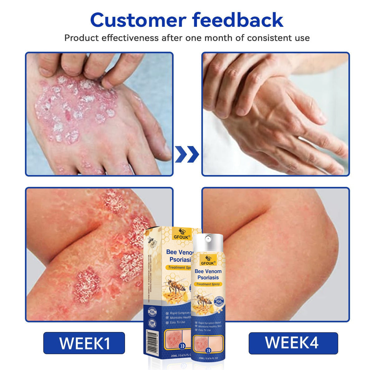 🧑‍⚕️𝑫𝒆𝒓𝒎𝒂𝒕𝒐𝒍𝒐𝒈𝒊𝒔𝒕-𝑪𝒓𝒆𝒂𝒕𝒆𝒅 | GFOUK® 🔥 𝑷𝒓𝑶𝑮𝑹𝑬𝑺𝑺𝑰𝑽𝑬 𝑩𝒆𝒆 𝑽𝒆𝒏𝒐𝒎 𝑺𝒑𝒓𝒂𝒚 - 𝐀𝐝𝐯𝐚𝐧𝐜𝐞𝐝 𝐏𝐬𝐨𝐫𝐢𝐚𝐬𝐢𝐬 𝐂𝐥𝐞𝐚𝐫𝐚𝐧𝐜𝐞 𝐒𝐨𝐥𝐮𝐭𝐢𝐨𝐧 (𝟏𝟎𝐱 𝐒𝐭𝐫𝐨𝐧𝐠𝐞𝐫 𝐓𝐡𝐚𝐧 𝐂𝐫𝐞𝐚𝐦𝐬, 𝐑𝐞𝐬𝐮𝐥𝐭𝐬 𝐢𝐧 𝟕 𝐃𝐚𝐲𝐬) ✅ 𝐒𝐭𝐞𝐫𝐨𝐢𝐝-𝐅𝐫𝐞𝐞, 𝐍𝐚𝐭𝐮𝐫𝐚𝐥, 𝐌𝐚𝐝𝐞 𝐢𝐧 𝐔𝐒𝐀 - 𝐒𝐮𝐢𝐭𝐚𝐛𝐥𝐞 𝐟𝐨𝐫 𝐀𝐥𝐥 𝐒𝐤𝐢𝐧 𝐓𝐲𝐩𝐞𝐬