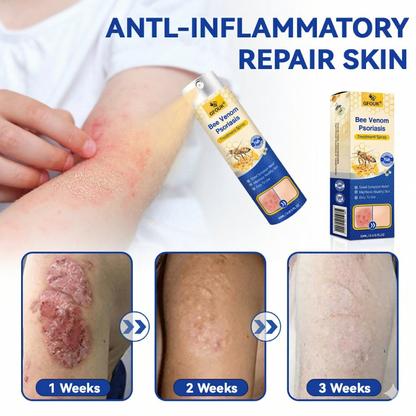 🧑‍⚕️𝑫𝒆𝒓𝒎𝒂𝒕𝒐𝒍𝒐𝒈𝒊𝒔𝒕-𝑪𝒓𝒆𝒂𝒕𝒆𝒅 | GFOUK® 🔥 𝑷𝒓𝑶𝑮𝑹𝑬𝑺𝑺𝑰𝑽𝑬 𝑩𝒆𝒆 𝑽𝒆𝒏𝒐𝒎 𝑺𝒑𝒓𝒂𝒚 - 𝐀𝐝𝐯𝐚𝐧𝐜𝐞𝐝 𝐏𝐬𝐨𝐫𝐢𝐚𝐬𝐢𝐬 𝐂𝐥𝐞𝐚𝐫𝐚𝐧𝐜𝐞 𝐒𝐨𝐥𝐮𝐭𝐢𝐨𝐧 (𝟏𝟎𝐱 𝐒𝐭𝐫𝐨𝐧𝐠𝐞𝐫 𝐓𝐡𝐚𝐧 𝐂𝐫𝐞𝐚𝐦𝐬, 𝐑𝐞𝐬𝐮𝐥𝐭𝐬 𝐢𝐧 𝟕 𝐃𝐚𝐲𝐬) ✅ 𝐒𝐭𝐞𝐫𝐨𝐢𝐝-𝐅𝐫𝐞𝐞, 𝐍𝐚𝐭𝐮𝐫𝐚𝐥, 𝐌𝐚𝐝𝐞 𝐢𝐧 𝐔𝐒𝐀 - 𝐒𝐮𝐢𝐭𝐚𝐛𝐥𝐞 𝐟𝐨𝐫 𝐀𝐥𝐥 𝐒𝐤𝐢𝐧 𝐓𝐲𝐩𝐞𝐬