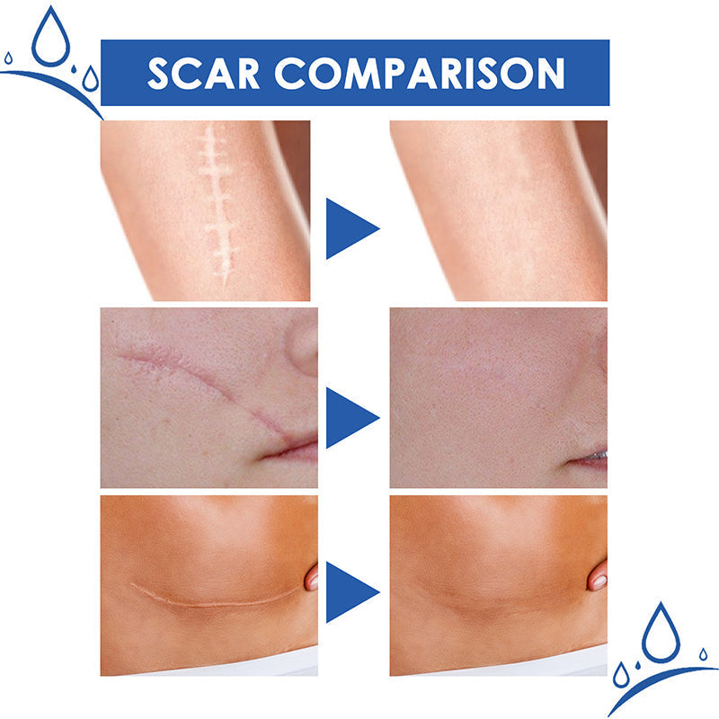 ⏰Final 3 Hours: 70%OFF🔥 GFOUK® Scar Repair Cream for Men and Women, fade scars and tighten skin in one step